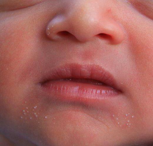 белые точки на носу у новорожденного когда проходят