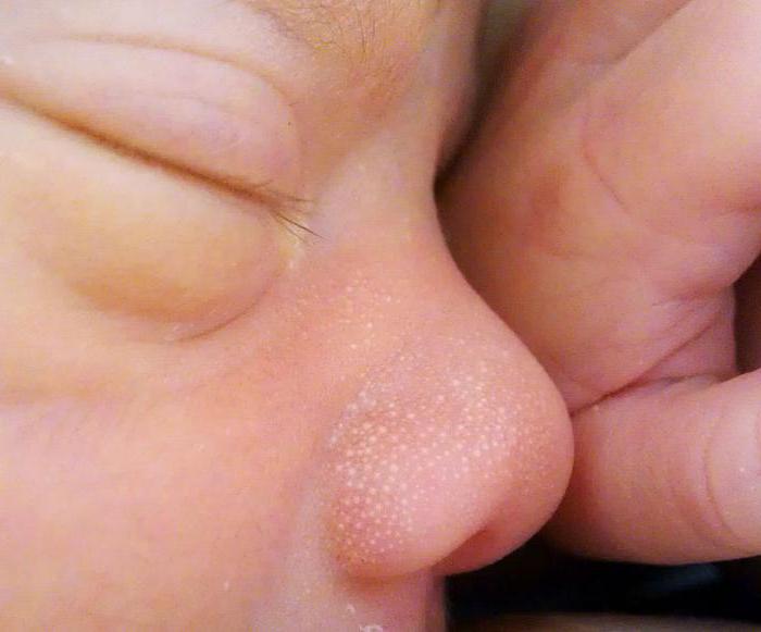 белые точки на носу у младенца 