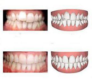Капы для зубов для выравнивания фото до и после