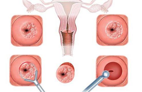 прижигание эрозии шейки радиоволнами