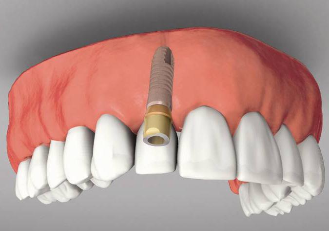 импланты зубов отзывы вред противопоказания
