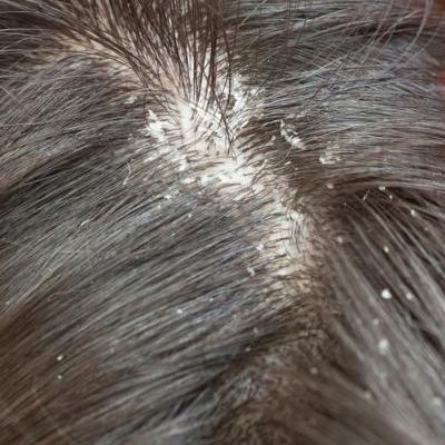 scalp peeling in the salon