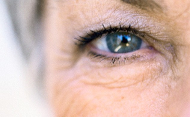 псевдоэксфолиативный синдром обоих глаз