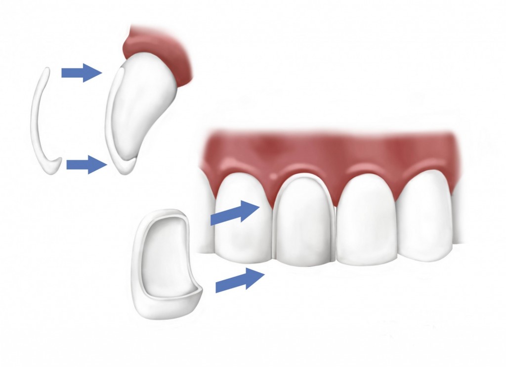 устранение щели между зубами с помощью виниров