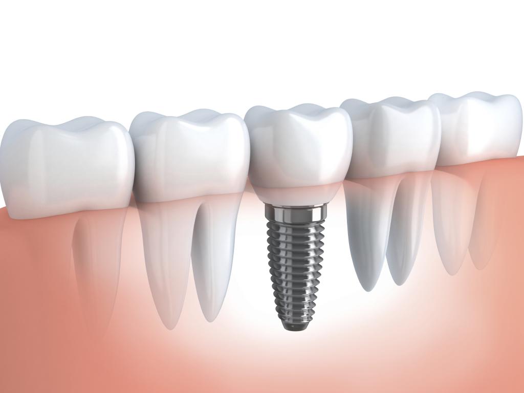 устранение щели между зубами с помощью имплантата