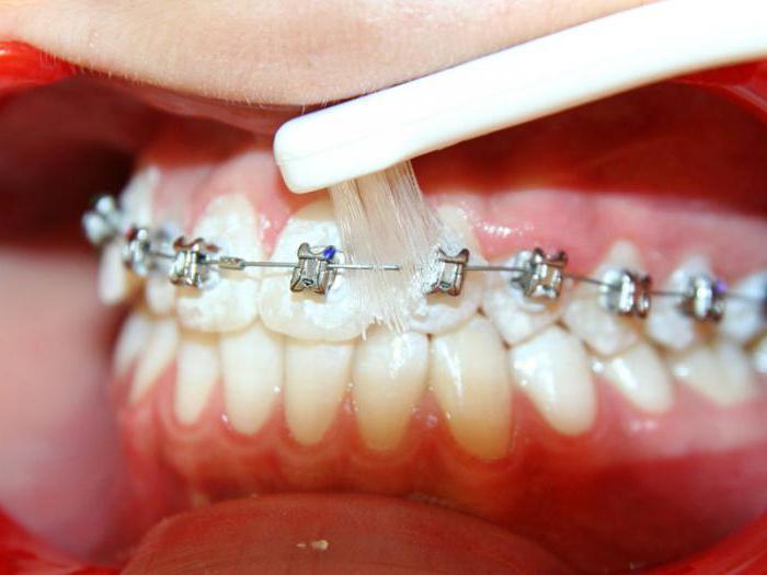 ортодонтическая зубная щетка для брекетов 
