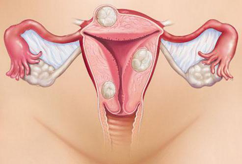 Что могут означают сильные боли при менструации