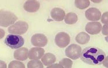 агранулоцитоз анализ крови