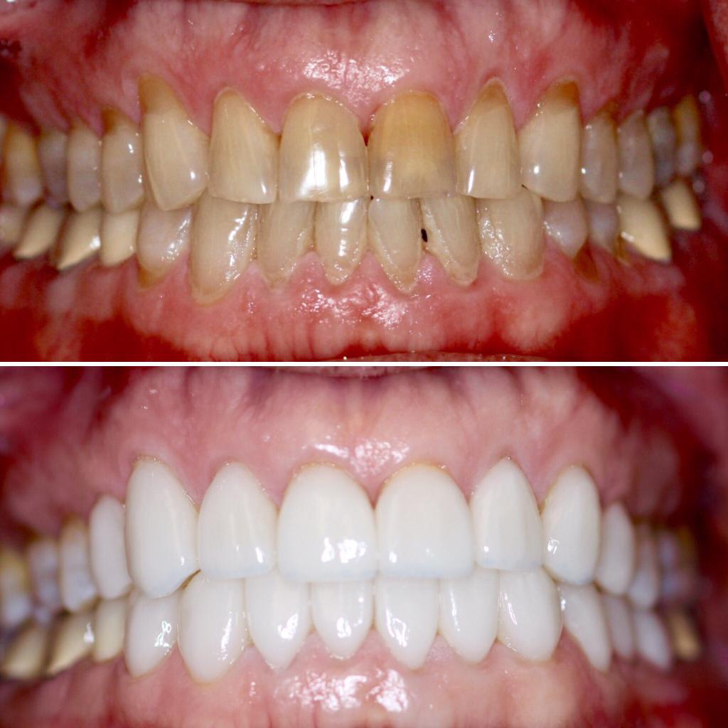 Виниры на зубы фото до и после