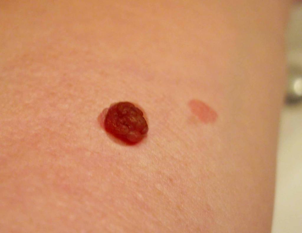 Moles on the stomach