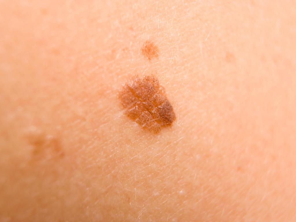 Moles on the stomach