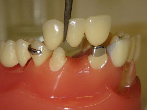 постановка искусственных зубов