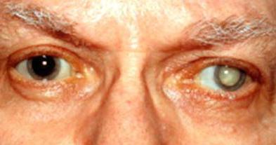 Вторичная катаракта после замены хрусталика противопоказания
