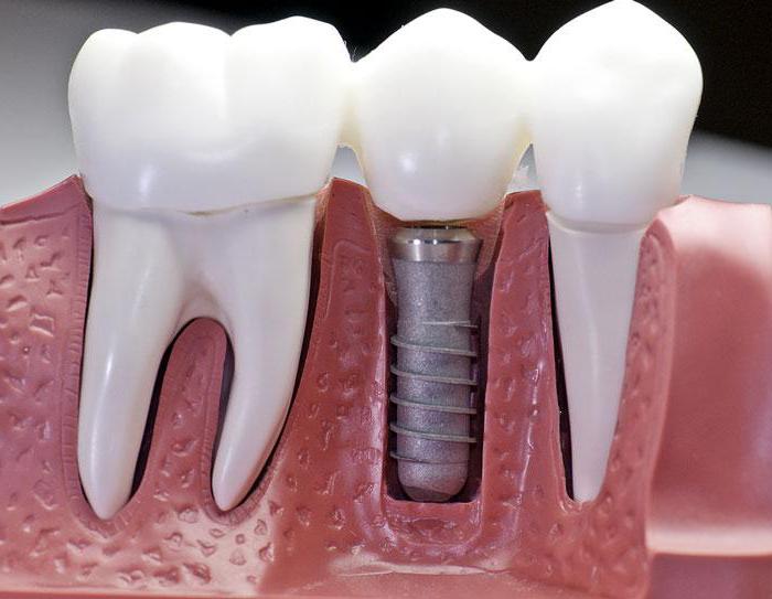 несъемные протезы для зубов какие лучше