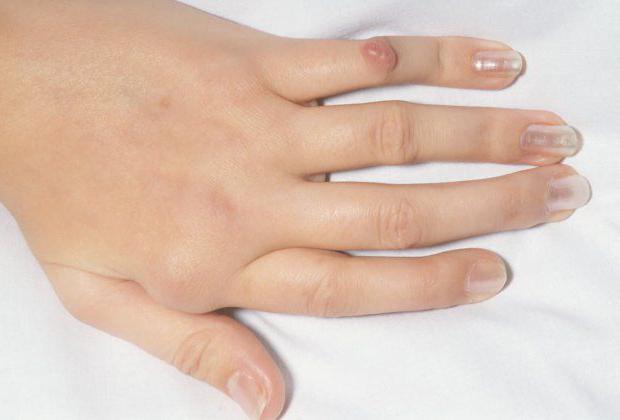 Ревматоидный узелок на пальце