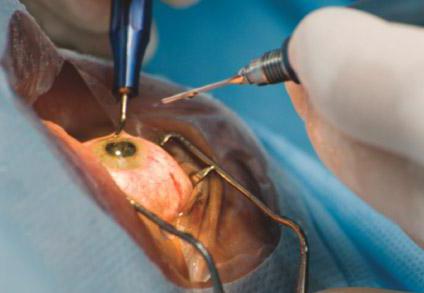 Факоэмульсификация катаракты имплантацией интраокулярной линзы