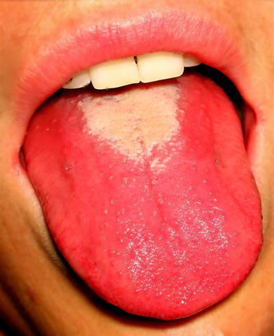 Ярко красный язык при ангине у детей thumbnail