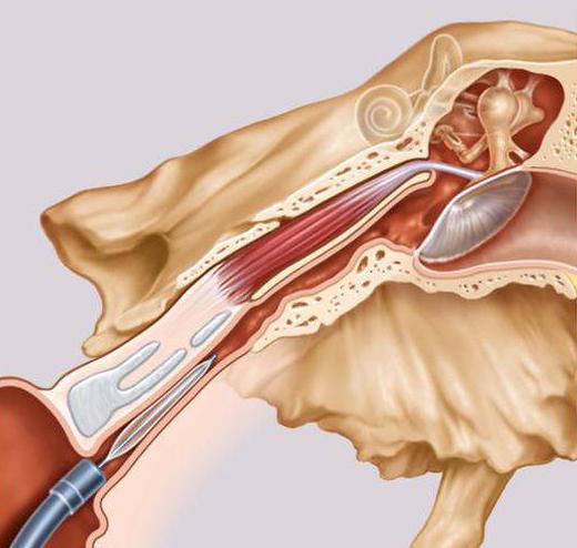 воспаление слуховой евстахиевой трубы лечение