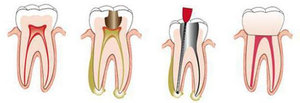 Удаление нерва зуба и пломбирование каналов