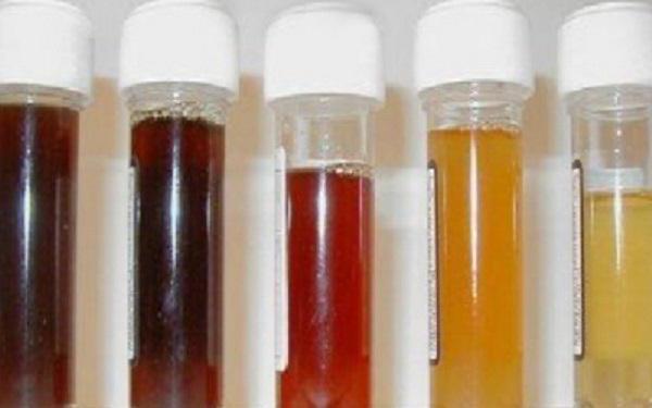 dark urine during pregnancy