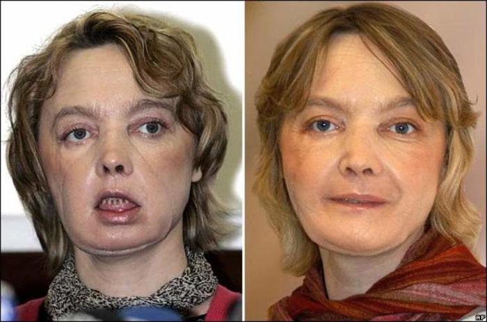 пересадка лица фото до и после