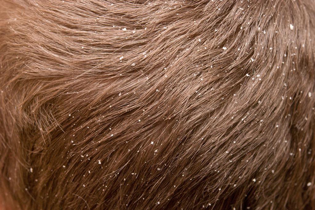 Как избавиться от пыли на волосах