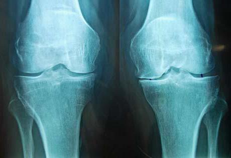 Травма мениска коленного сустава лечение