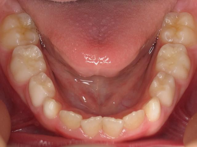 анатомия зубов нижней челюсти