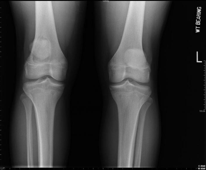 кости коленного сустава