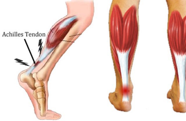 сухожилия на ноге