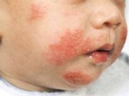 кожные заболевания у ребенка
