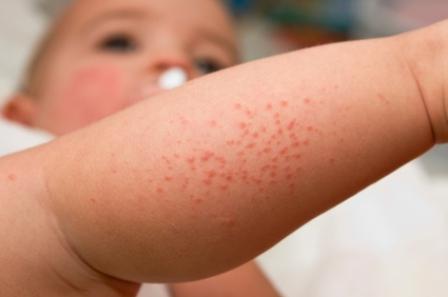 кожные заболевания у детей симптомы
