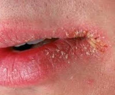 трещины в уголках губ лечение