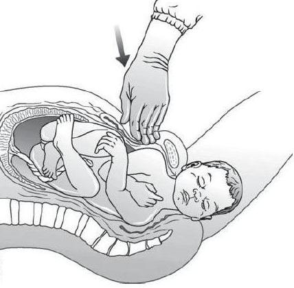 лонное сочленение при беременности