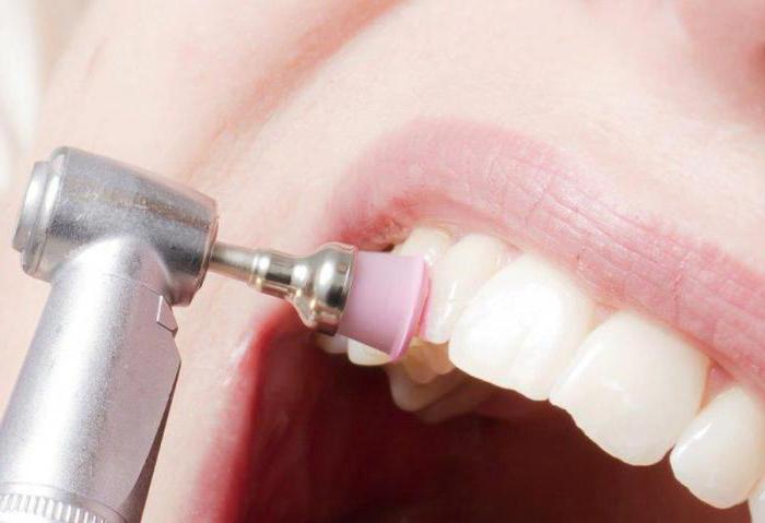 чистка зубов от зубного камня ультразвуком