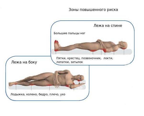 места образования пролежней