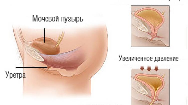 urinary incontinence