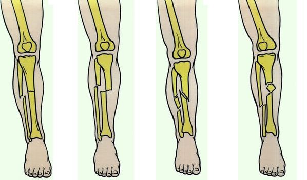 мкб перелом большеберцовой кости