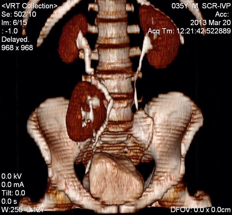 аномалии формы почек