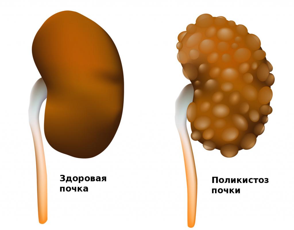 Аномалия почек: признаки, симптомы илечение