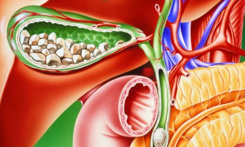 как лечить хронический холецистит и панкреатит