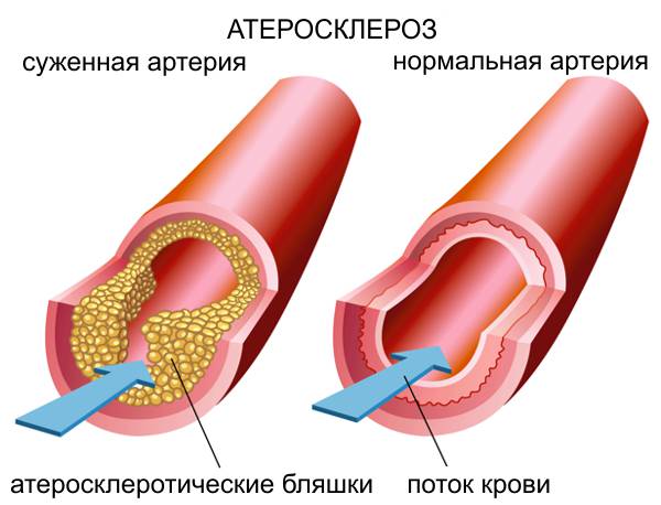 атеросклероз сосудов головного мозга как лечить