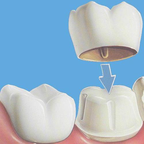 коронки на импланты какие лучше 