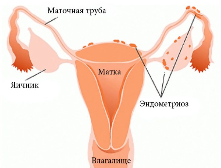 генитальный эндометриоз