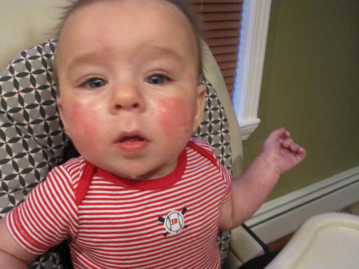 Красное пятно на щеке у ребенка 1 год thumbnail