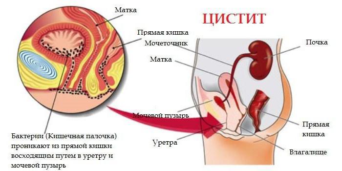 свечи при цистите