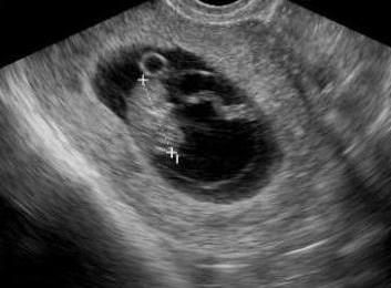 Срок беременности 6 недель фото размер плода фото thumbnail