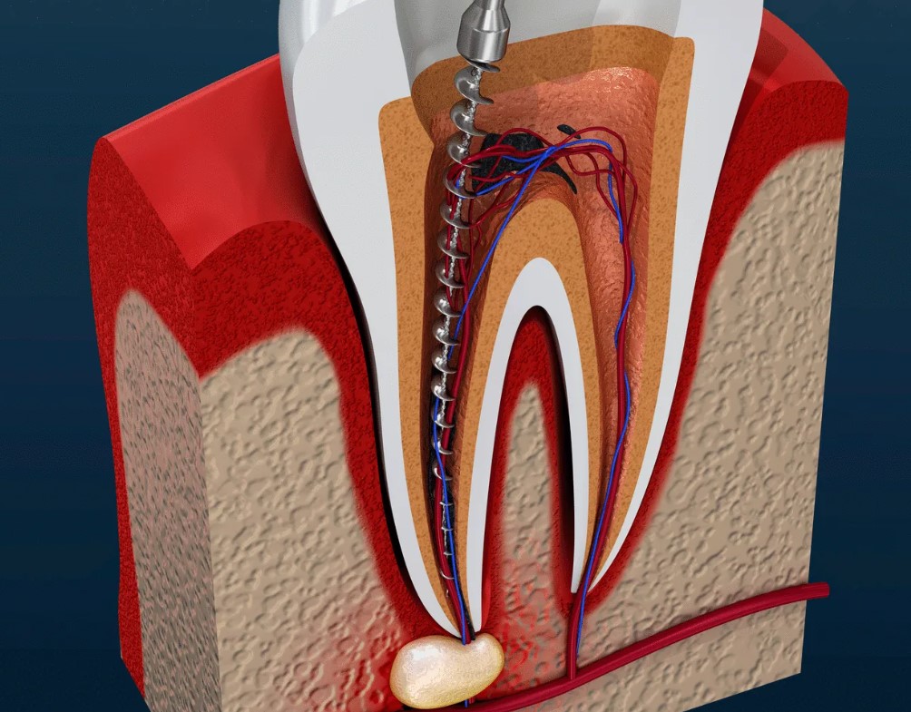 почему болит зуб без нерва 
