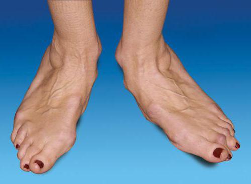 артрит стопы ног лечение