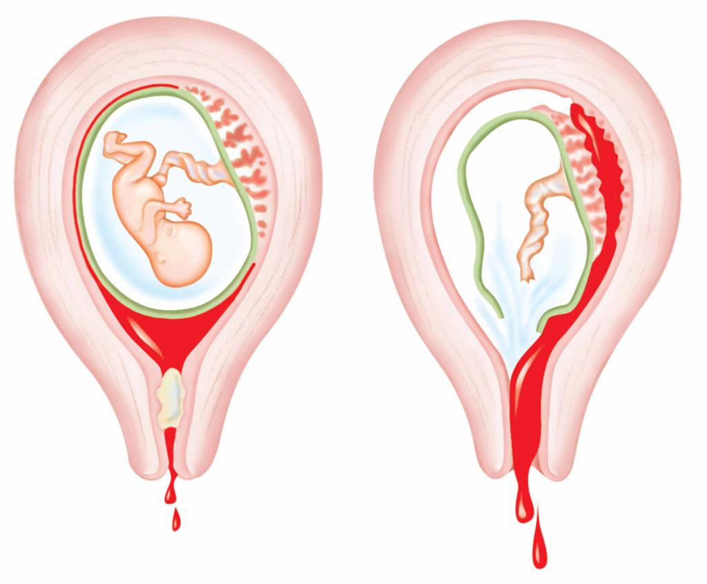 оргазм и гипертонус матки при беременности фото 90